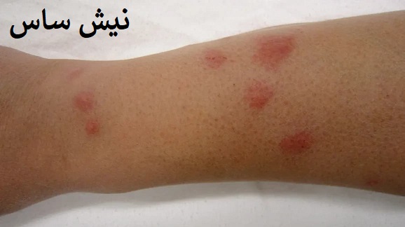 نیش ساس